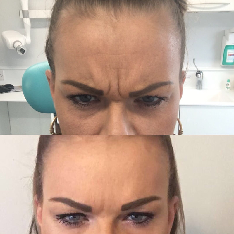 Before and After Botox® In Canterbury