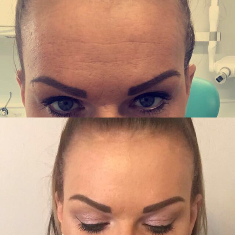 Before and After Botox® In Canterbury